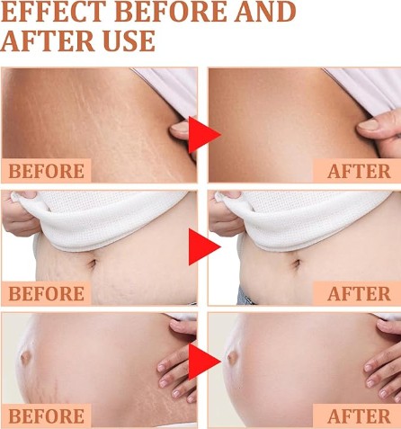 Eelhoe - Stretch Marks Removal Cream