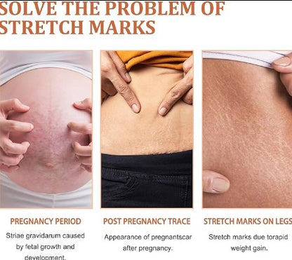 Eelhoe - Stretch Marks Removal Cream
